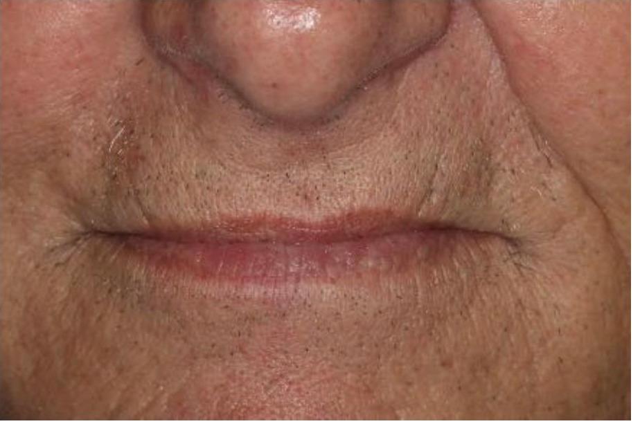 Upper Implant Bridge and Lower Overdenture