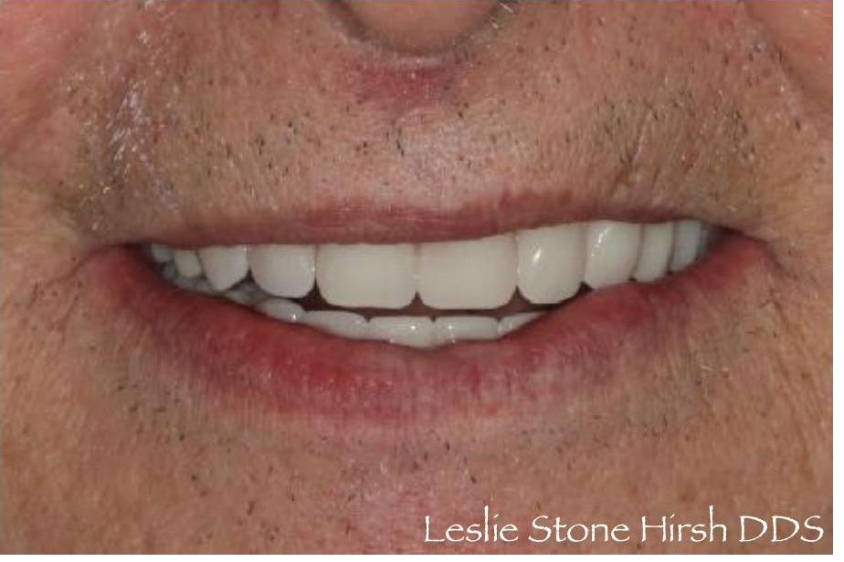 Upper Implant Bridge and Lower Overdenture