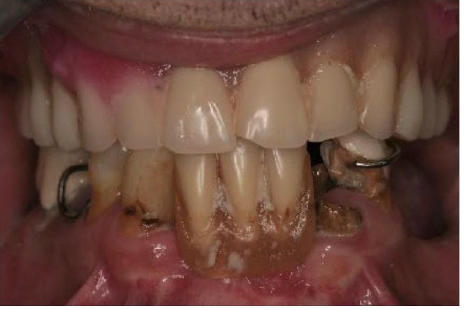 Upper Implant Bridge and Lower Overdenture