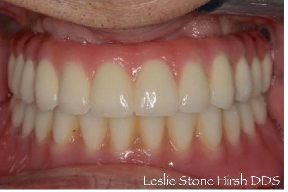 Upper Implant Bridge and Lower Overdenture
