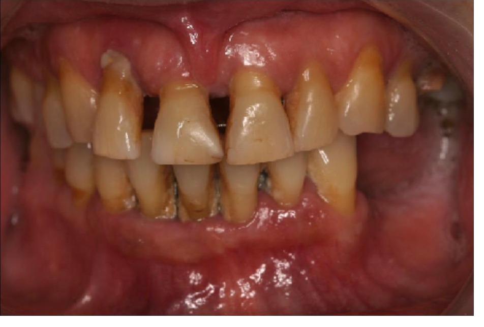 Upper and Lower Implant Bridges
