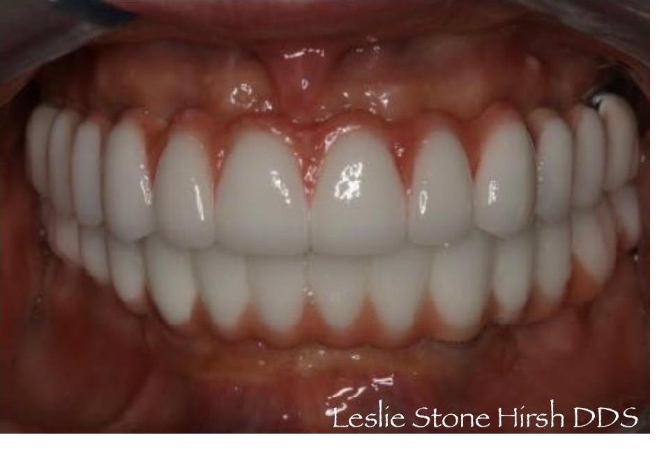 Upper and Lower Implant Bridges