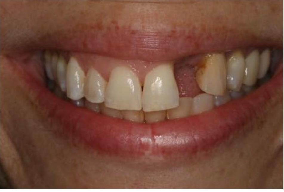 Implant Crown and Gingival Moulage