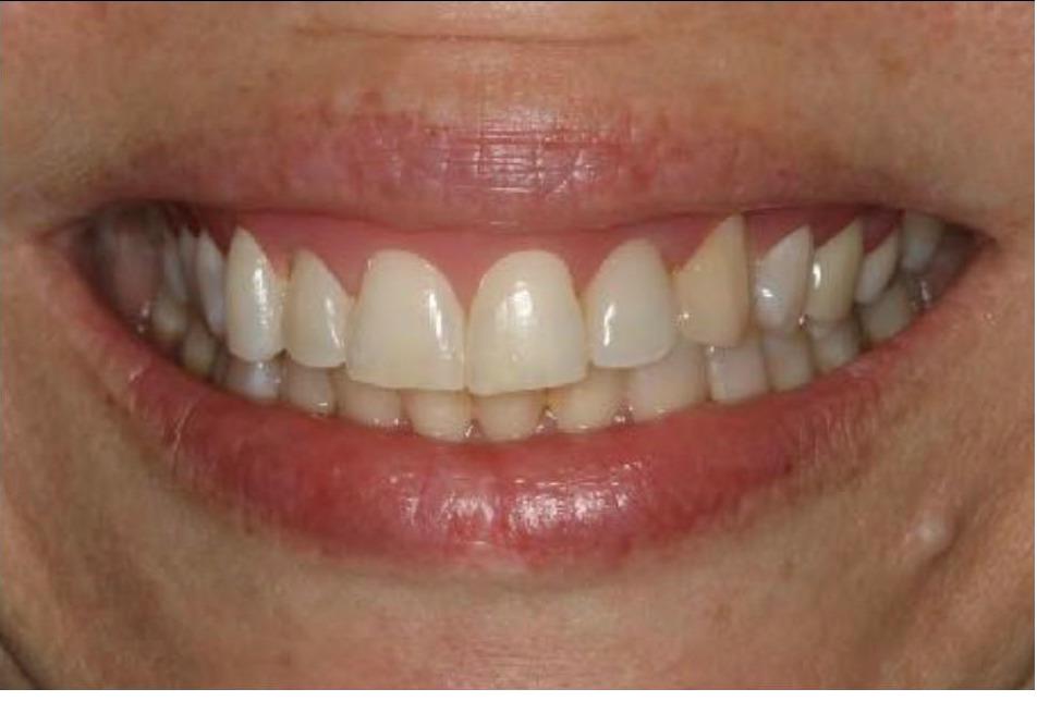 Implant Crown and Gingival Moulage