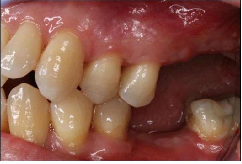Implant Crowns and Bridges
