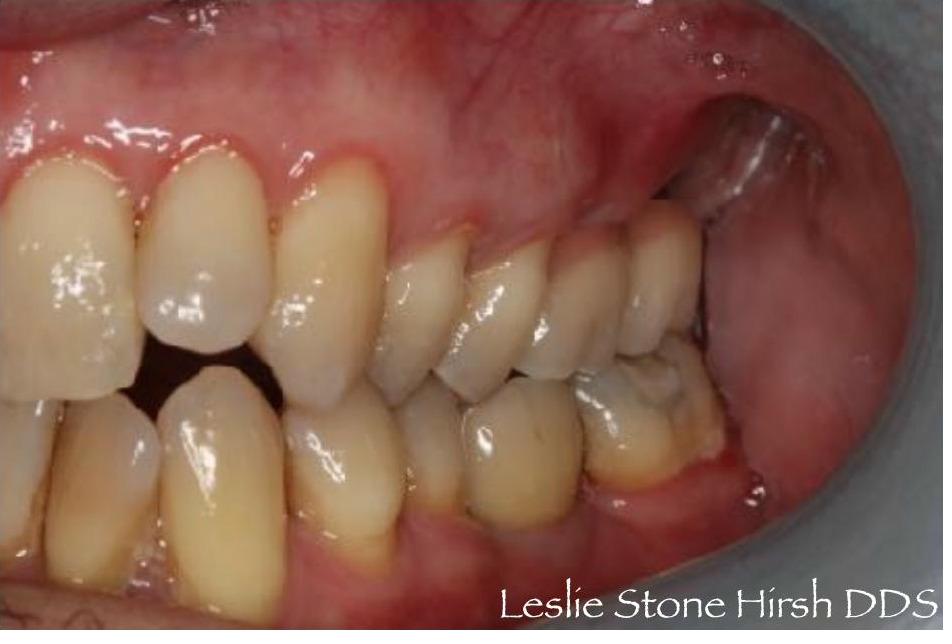 Implant Crowns and Bridges