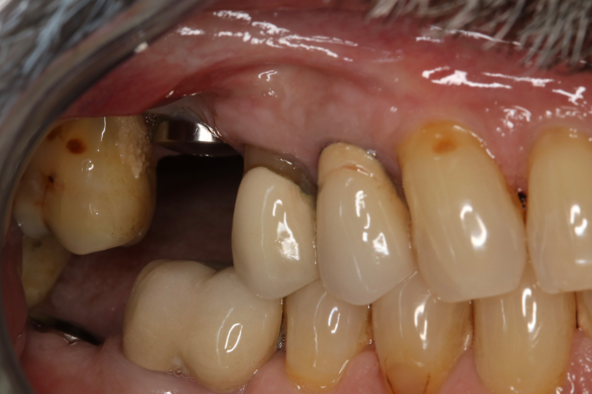 Upper and Lower Implant Crowns