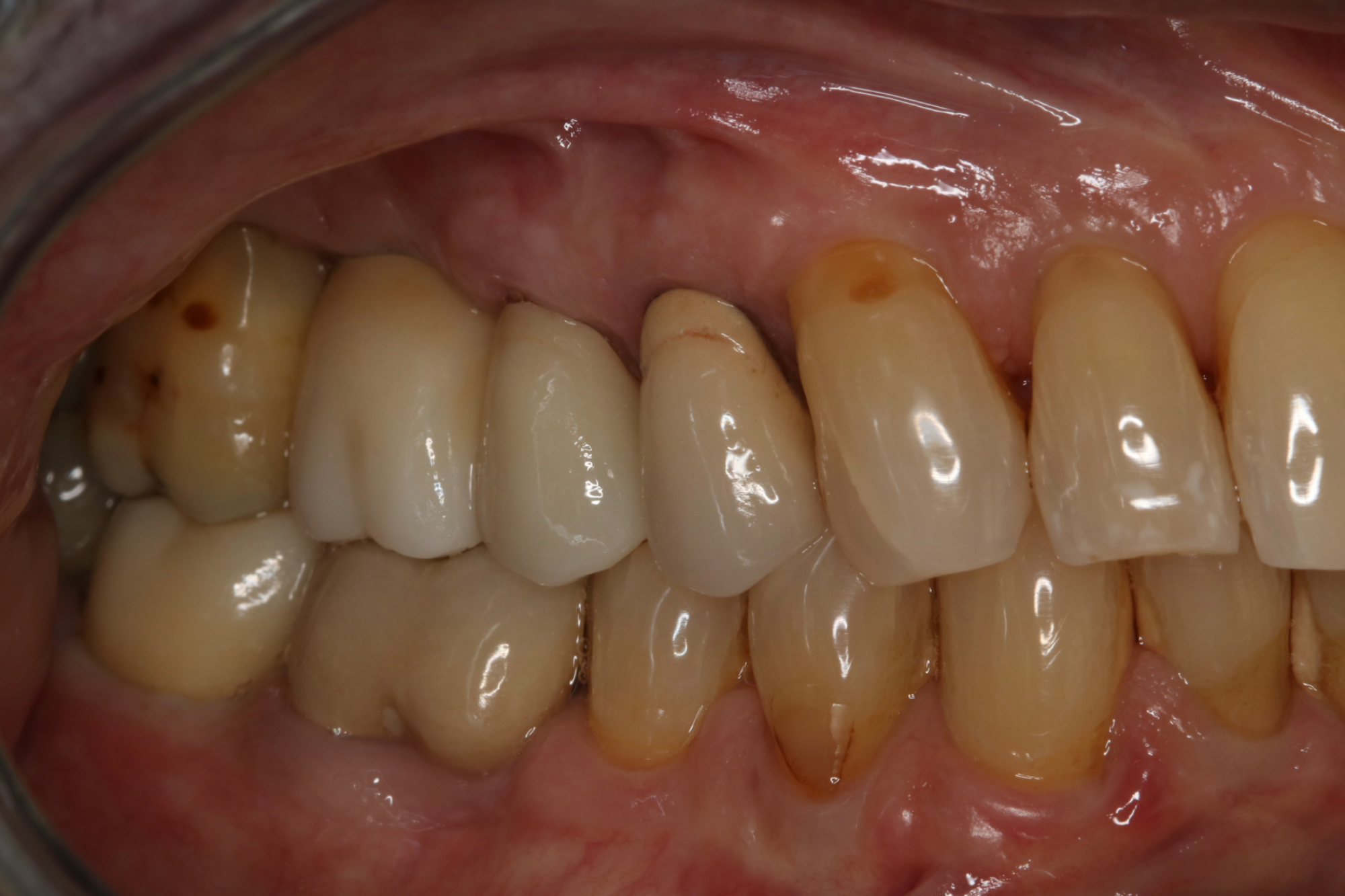 Upper and Lower Implant Crowns