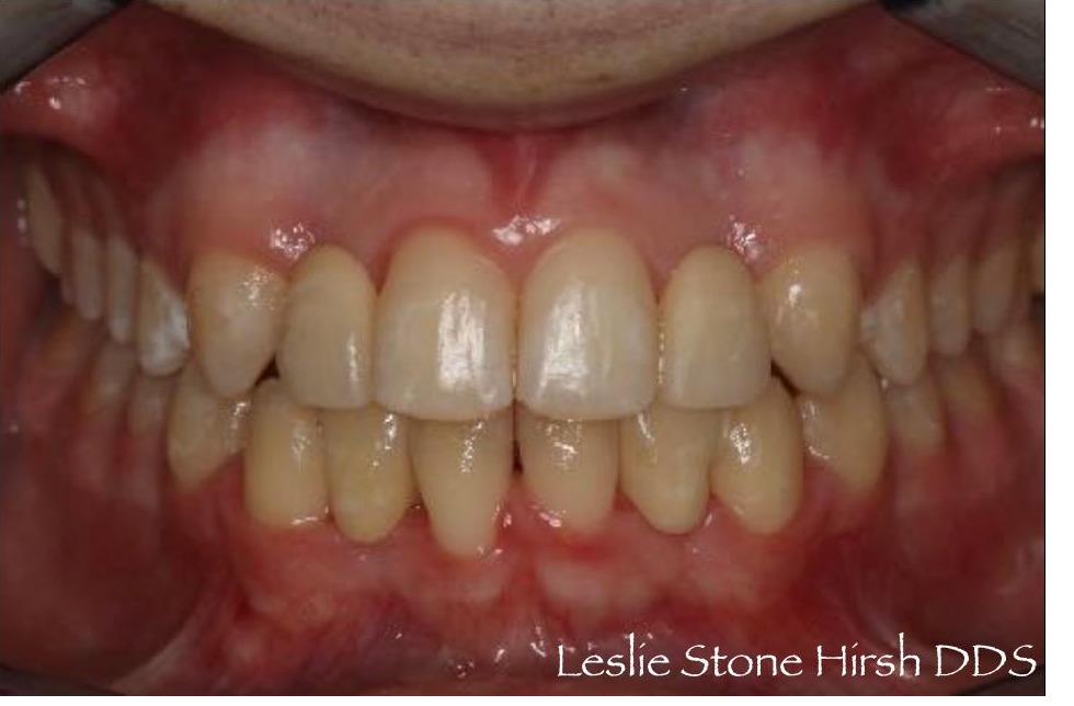 Resin Bonded (Maryland) Bridges