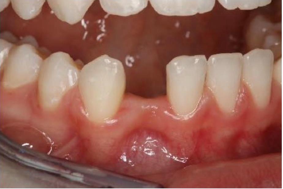 Resin Bonded (Maryland) Bridge