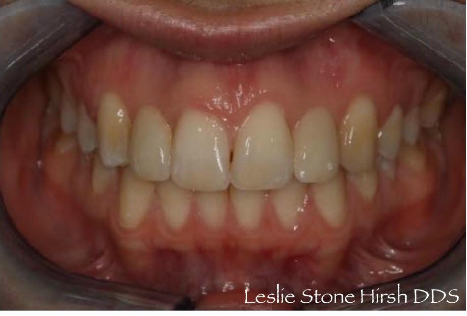 Resin Bonded (Maryland) Bridges