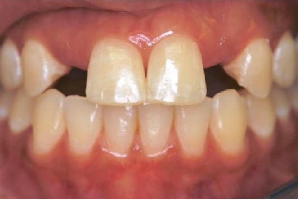 Resin Bonded (Maryland) Bridges