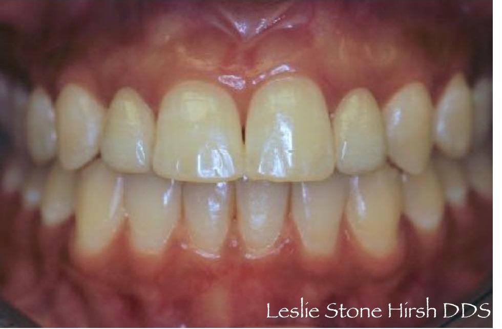 Resin Bonded (Maryland) Bridges