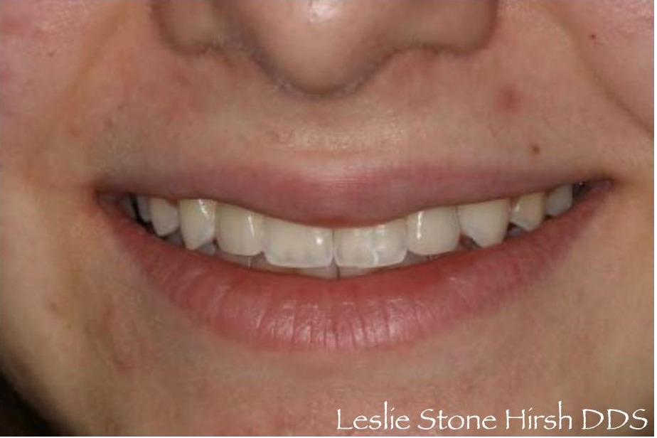 Resin Bonded (Maryland) Bridges