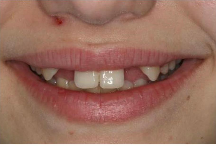 Resin Bonded (Maryland) Bridges