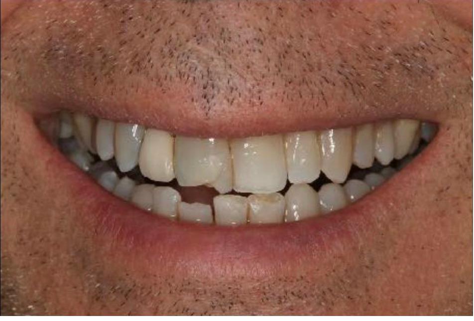 Provisionals (Temporary) Bridge