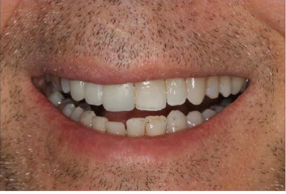 Provisionals (Temporary) Bridge