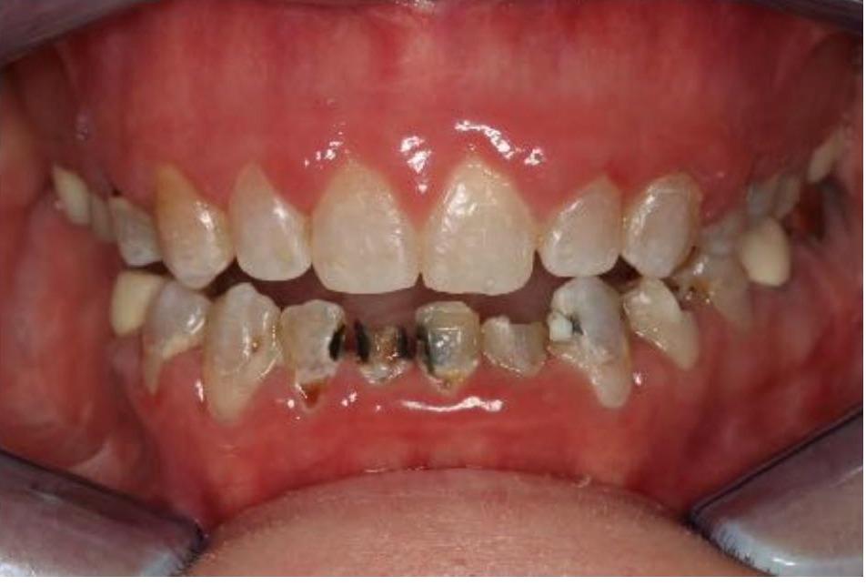 Provisionals (Temporary) Bridge