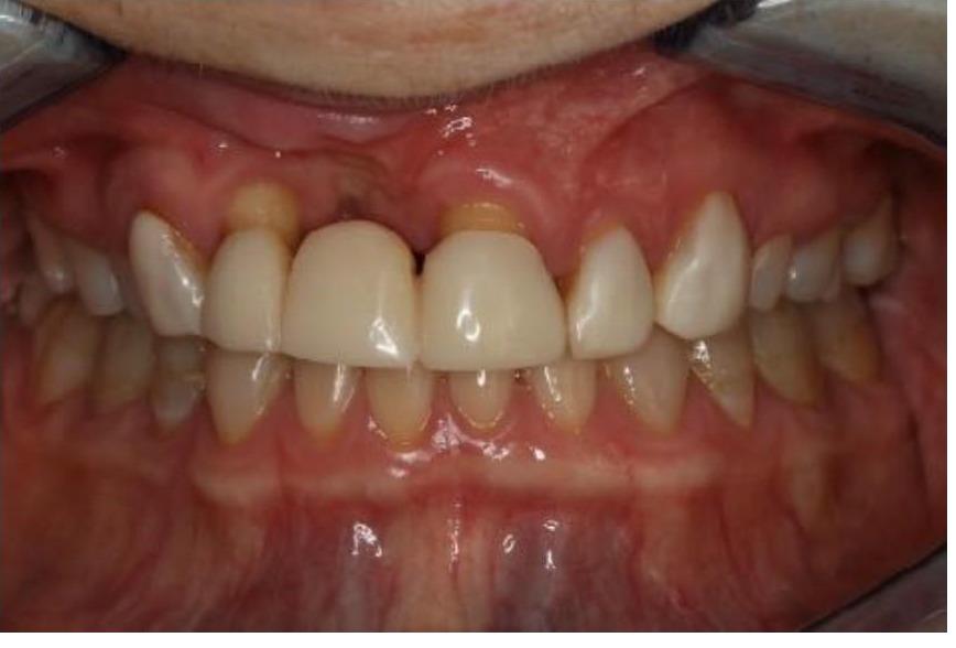 Provisionals (Temporary) Bridges