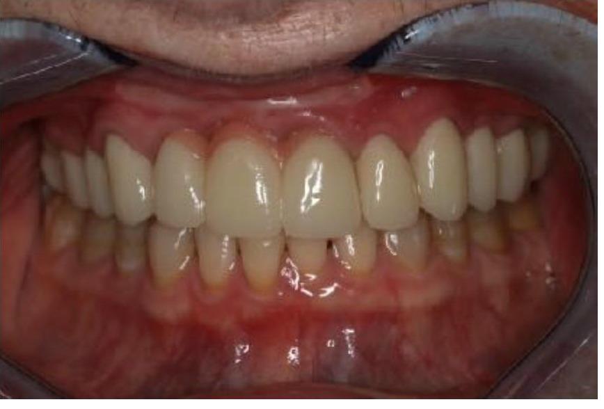 Provisionals (Temporary) Bridges