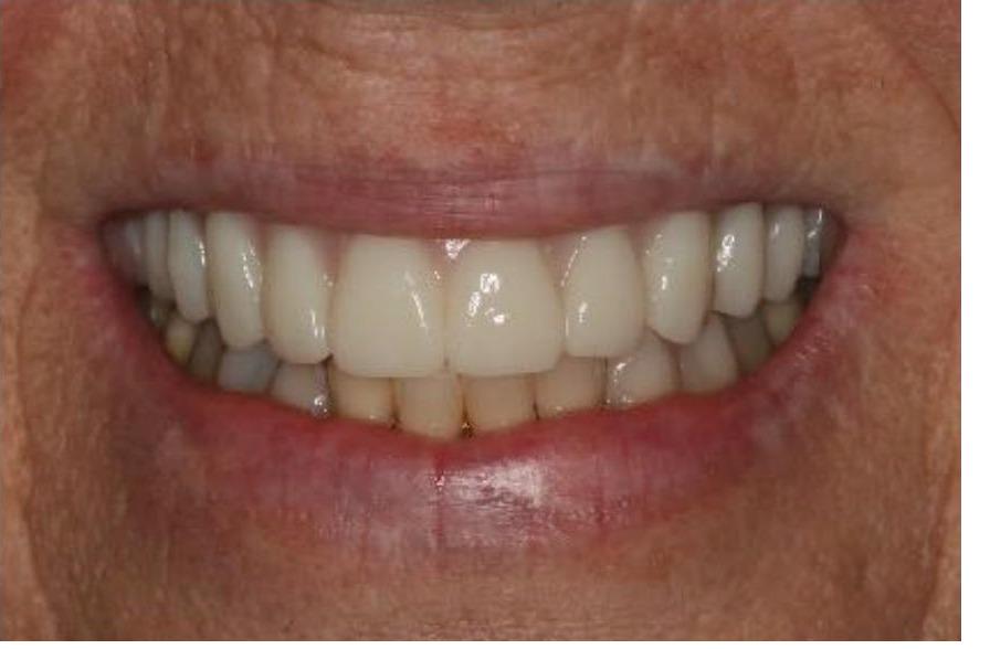 Provisionals (Temporary) Implant Bridge