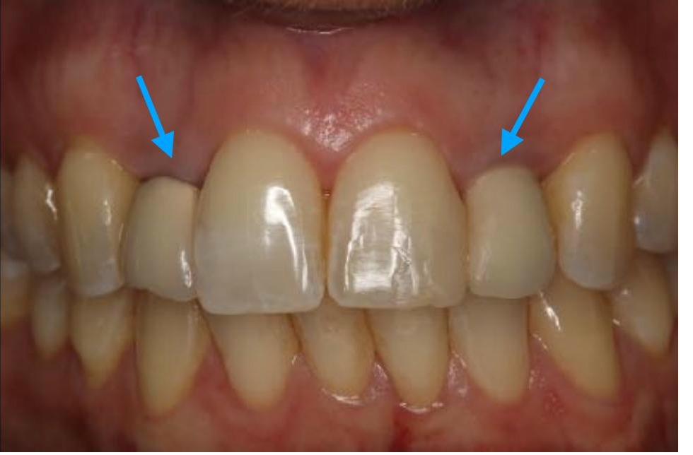 Provisionals (Temporary) Implant Crowns