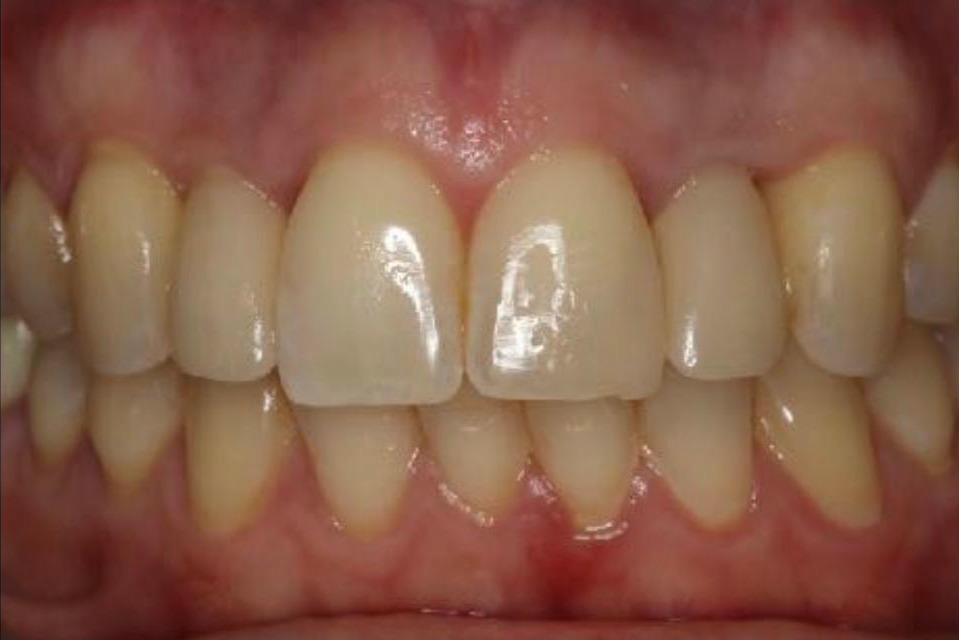 Provisionals (Temporary) Implant Crowns
