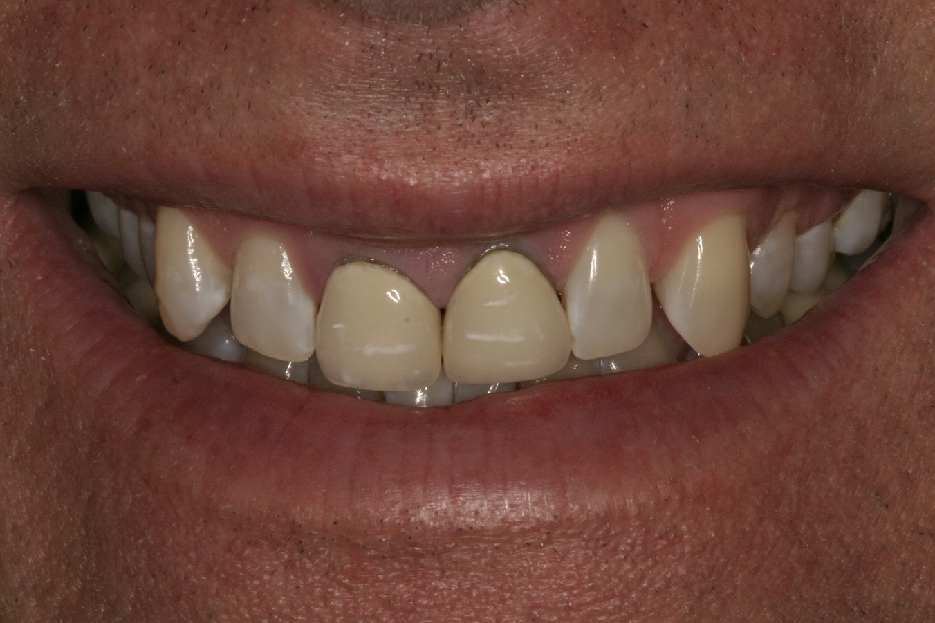 Provisionals (Temporary Crowns)