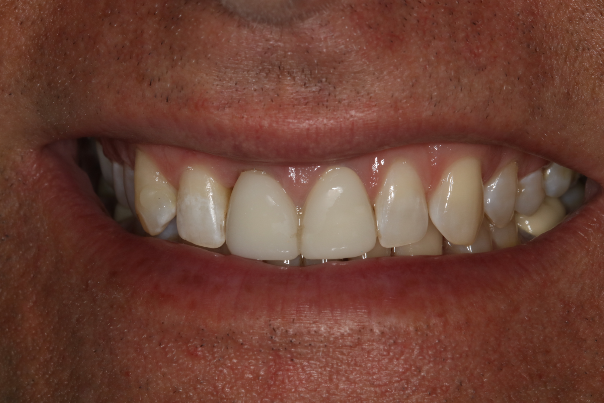 Provisionals (Temporary Crowns)