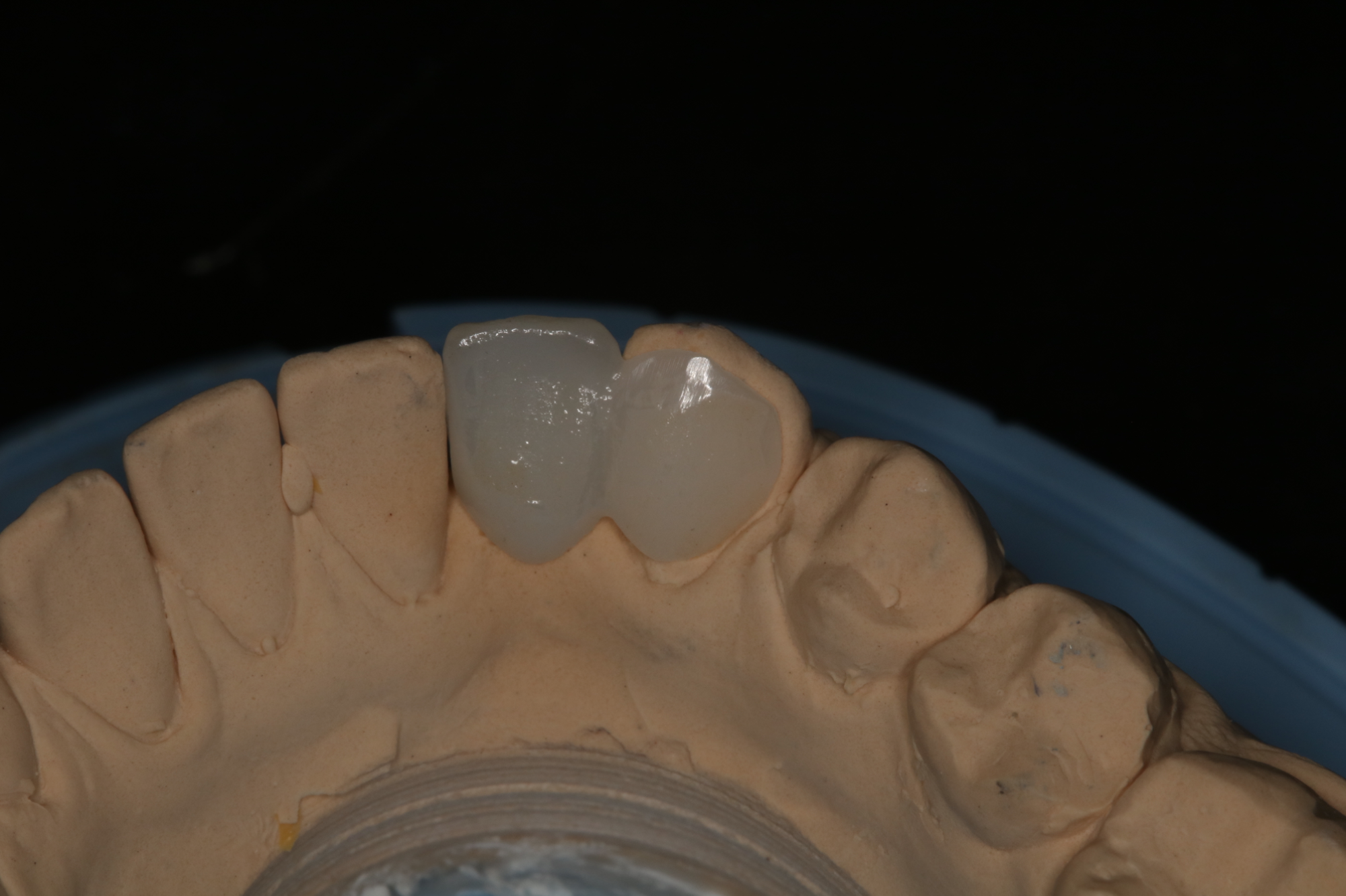 Resin Bonded Bridges