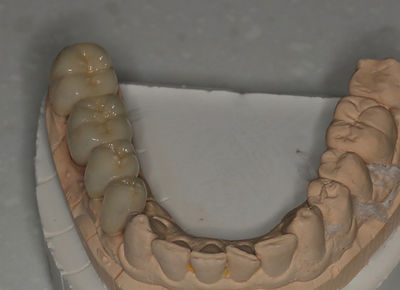 Esthetic Crowns and Bridges