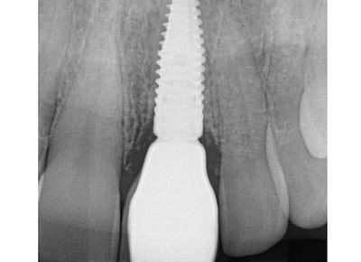Dental Implants
