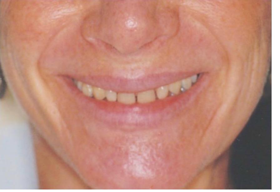 Veneers