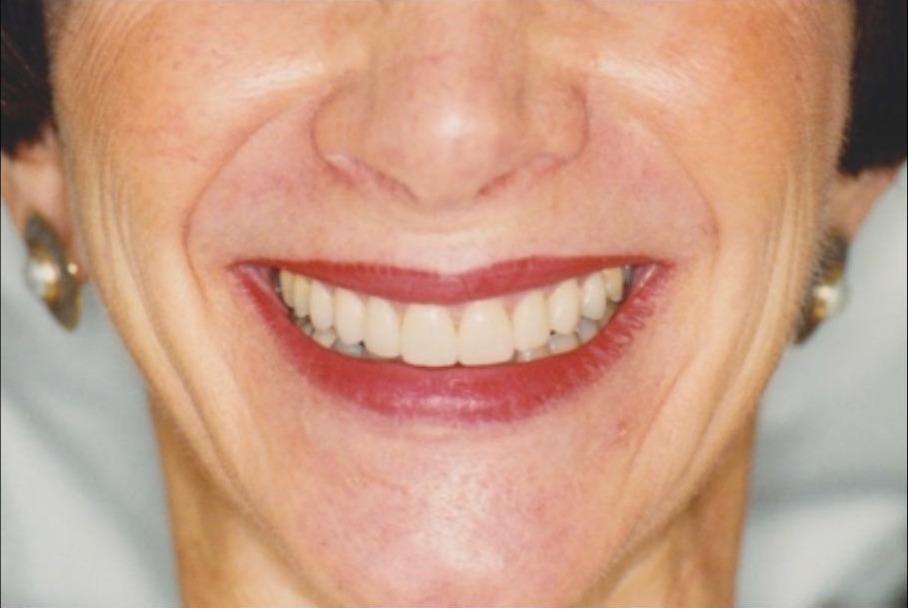 Veneers
