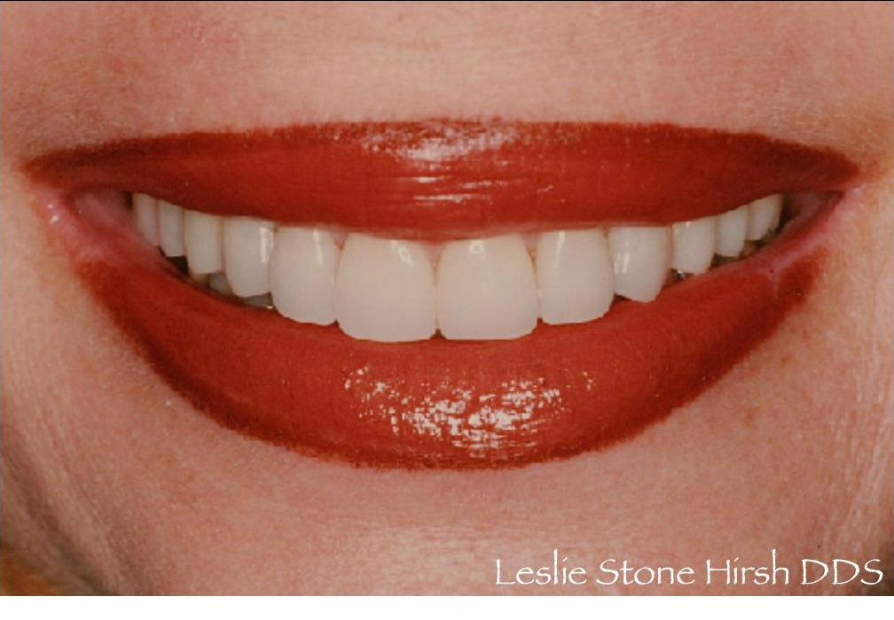 Veneers