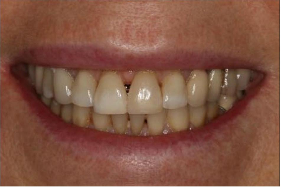 Veneers and Crowns