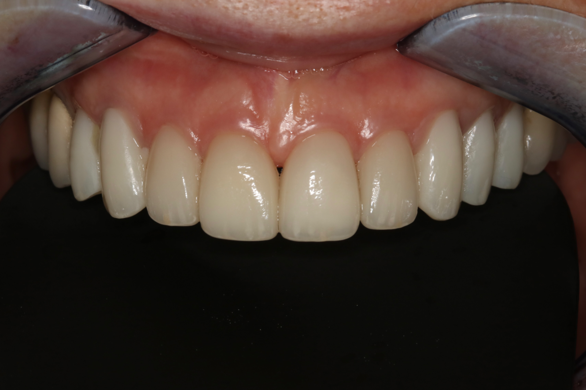 Veneers and Crowns