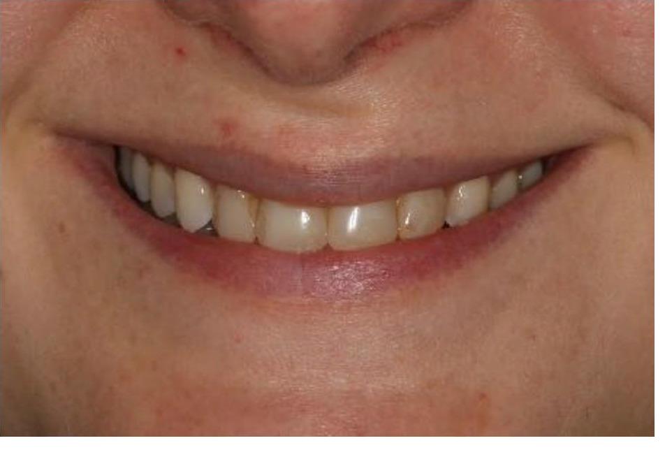 Veneers