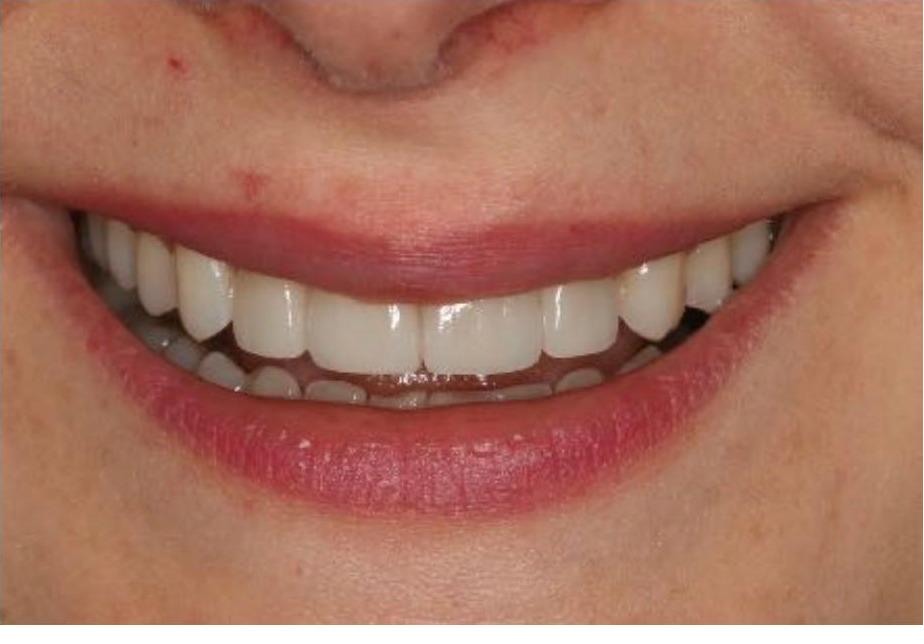 Veneers